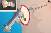 Симулятор хирурга 4 Операция на ухо